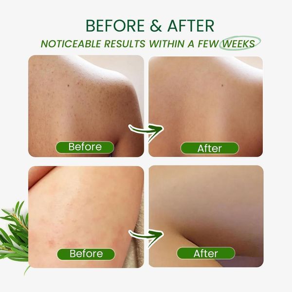 Гель для душа успокаивает фолликулит, акне, зуд Pharmbanner Tea Tree Antifungal Body Wash 350 мл 2894996618 фото